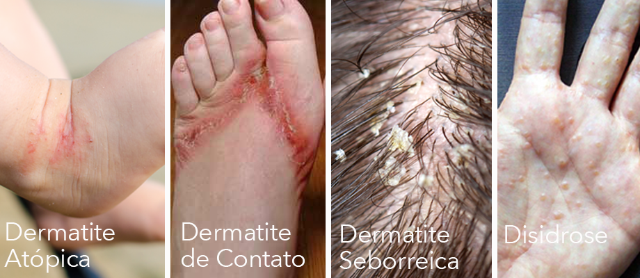 Dermatites