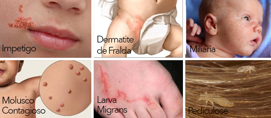 Dermatologia pediátrica