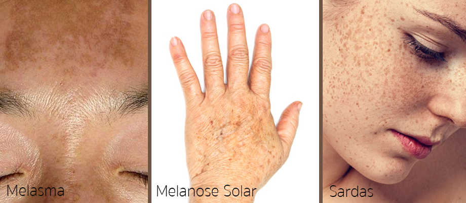 Melasma e outras manchas